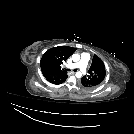 Pleural Effusion Tags Differential Diagnosis of